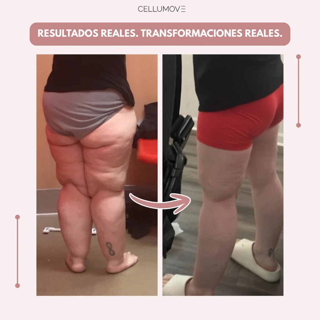Cellumove 3D Legging – Despídete del dolor y la fatiga del lipedema de forma natural
