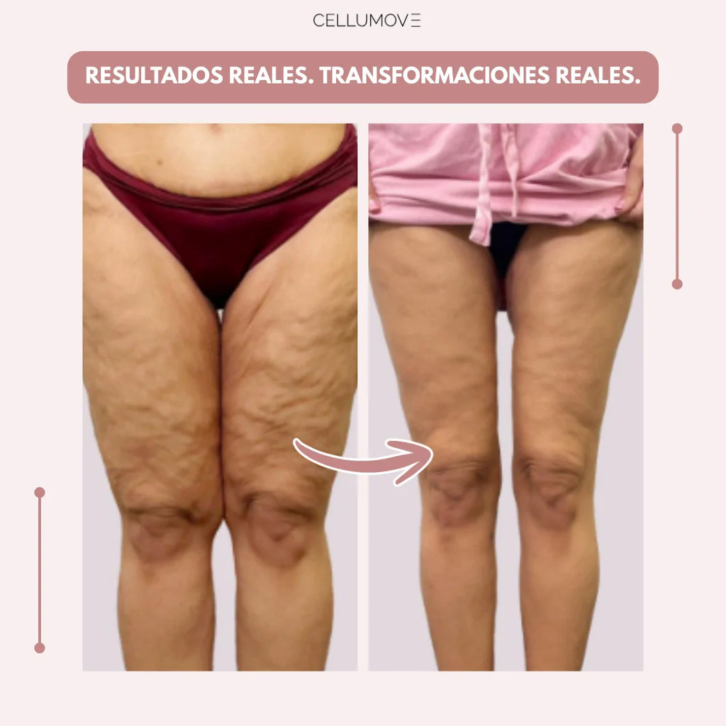 Cellumove 3D Legging – Despídete del dolor y la fatiga del lipedema de forma natural